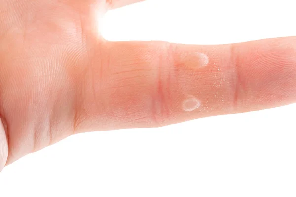 Hand Finger Blisters Callus Medical Trauma Dry Skin Dermatology Care — Stock Photo, Image