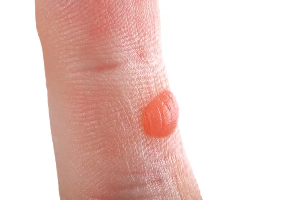 Finger Redness Blister Inflammation Callus Workers Hand Trauma Hard Work — Stock Photo, Image