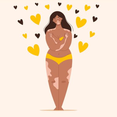 Sarı mayolu, vitiligolu güzel, genç esmer kadın. Derinin özellikleri, melanin. Vücuduna olan sevgin olumlu. Vektör illüstrasyonu.