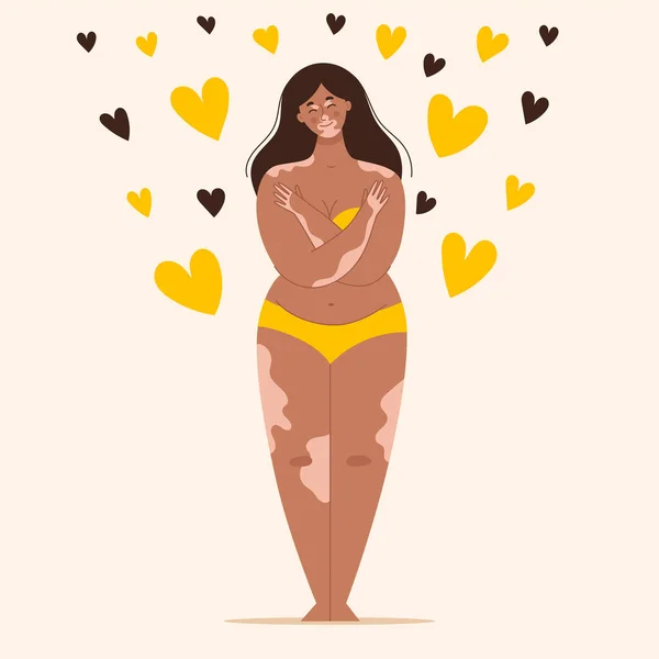 Krásná mladá brunetka s vitiligem ve žlutých plavkách. Vlastnosti kůže, melanin. Láska k tělu, pozitivita těla.Vektorová ilustrace — Stockový vektor