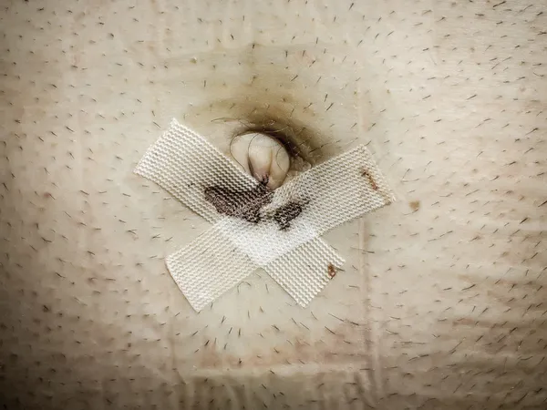 Wound umbilical hernia — Stock Image Wound umbilical hernia Stock Photo