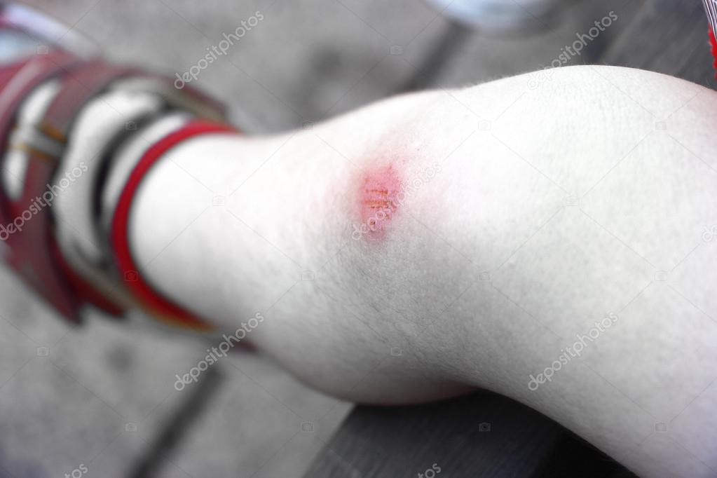 Young boy with scraped leg