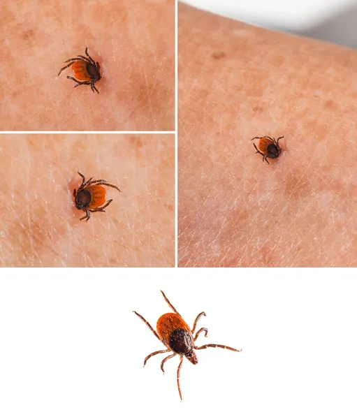 Tick on human skin — Stock Photo, Image