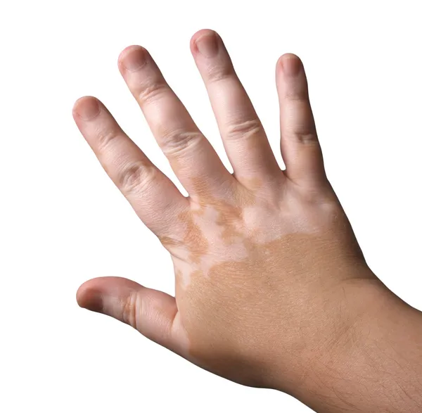 Vitiligo — Stockfoto