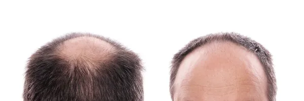 Hair loss — Stock Photo, Image