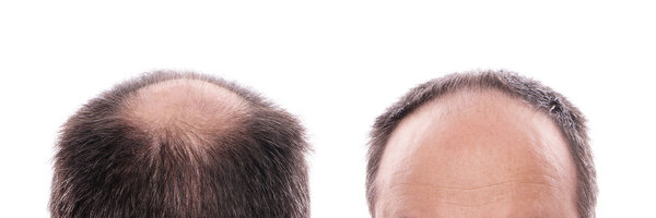 hair loss