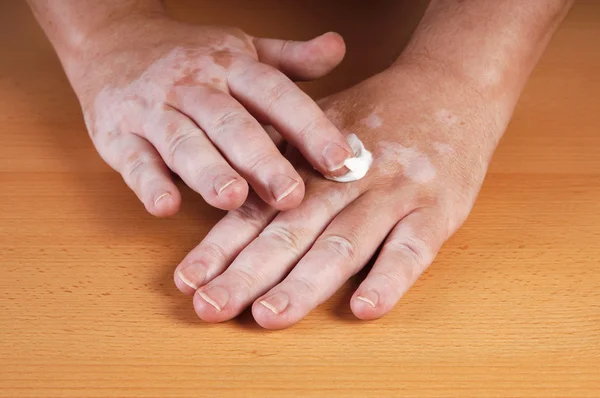 Vitiligo — Fotografia de Stock