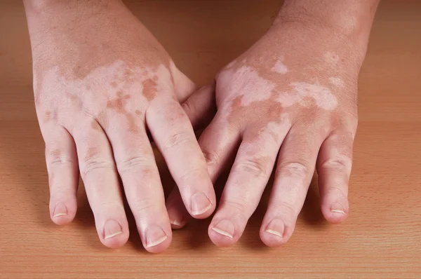 Vitiligo — Stockfoto