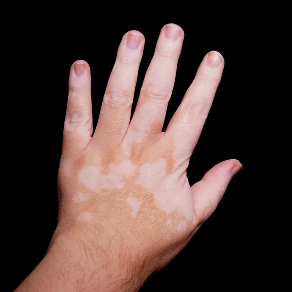Vitiligo — Stok fotoğraf