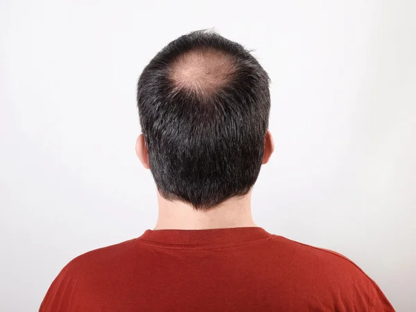 Hair loss — Stock Photo, Image