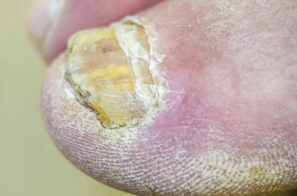 Uñas de los pies con infección fúngica común . —  Fotos de Stock