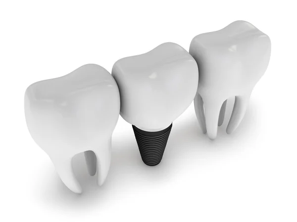 Tooth implant — Stock Photo, Image