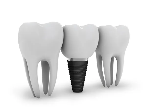 Зубной имплант — стоковое фото