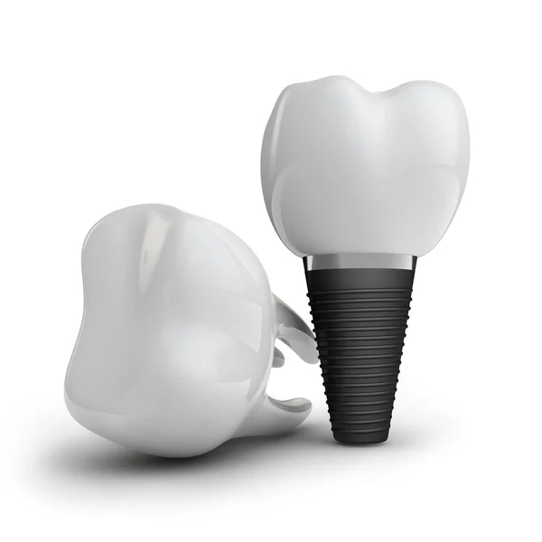 Tooth implant — Stock Photo, Image