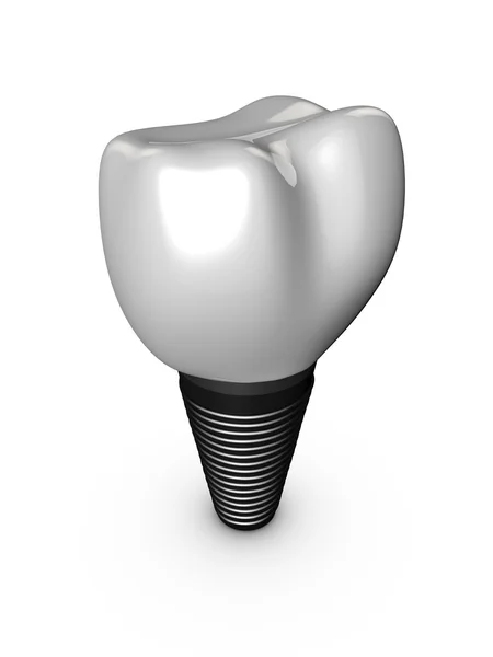 Tooth implant — Stock Photo, Image