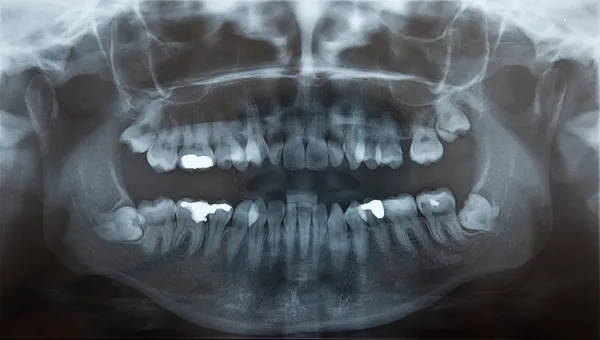 Raios-X de dentes sabedoria problemáticos para extração, e recheios — Fotografia de Stock