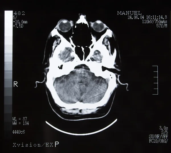 脳の断層撮影 — ストック写真