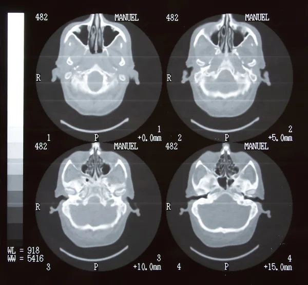 Brain Tomography — Stock Photo, Image