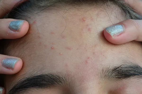 Acne — Stock Photo, Image