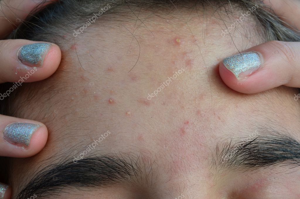 Managing Itchy Acne: Symptoms, Causes, and Treatment