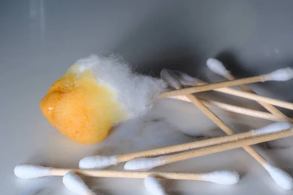 Cleaning Extreme Amount Ear Wax Using Cotton Swabs — Stock Fotó