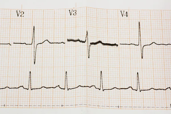心律失常 — 图库照片