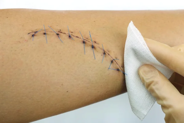 Stitched wound — Stock Photo, Image