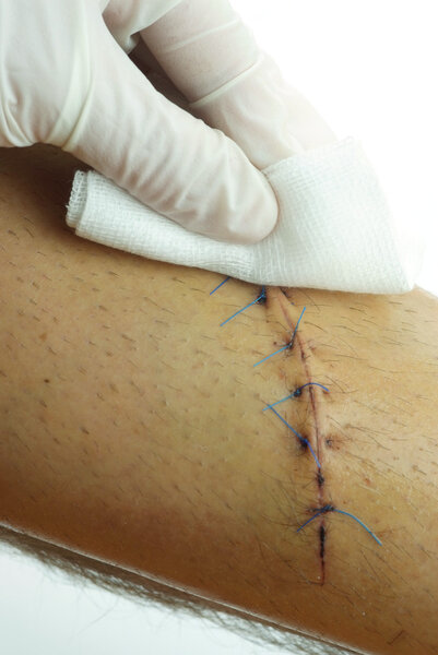 Очистка зашитых ран
