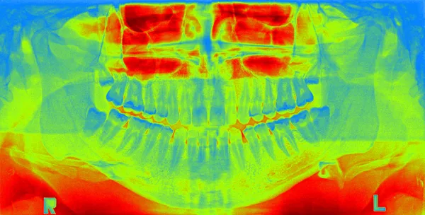 歯のパノラマのX線画像 — ストック写真