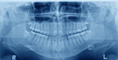 dişlerin panoramik x-ray görüntüsü