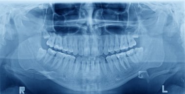 Panoramic x-ray image of teeth clipart