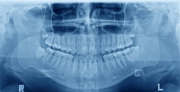 Panoramic x-ray image of teeth — https://st.depositphotos.com/1800166/2235/i/450/depositphotos_22350319-stock-photo-panoramic-x-ray-image-of.jpg
