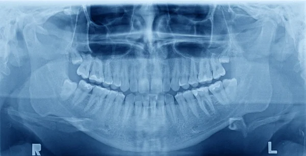 Dişlerin panoramik x-ray görüntüsü — Stok fotoğraf