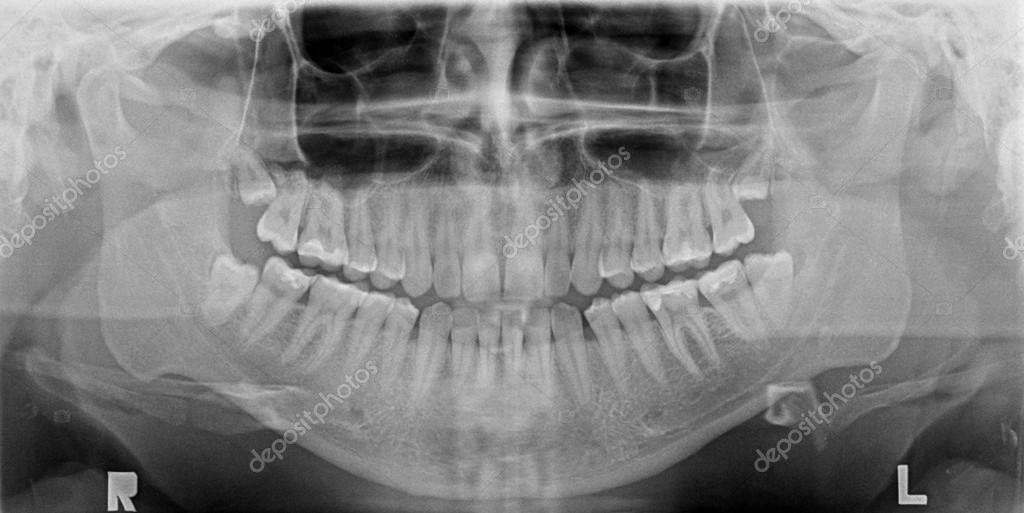panoramic xray