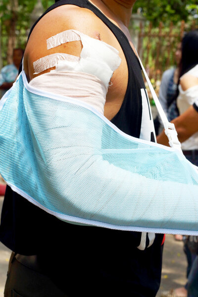 Men have been accidental arm plaster cast.