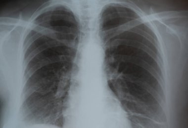 Röntgen filminde akciğerler, tıbbi geçmiş - zatürree ve tüberküloz hastalığı konsepti