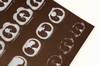Tomografi ile göğüs bölgesinin farklı açılardan röntgeni. Hesaplanmış tomografi teşhisi. 