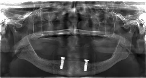 Rayos X de dientes con implantes —  Fotos de Stock