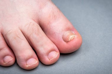 Onychomycosis fungal infection of toenail. Sick nail on the foot after damaging with tight shoes. 