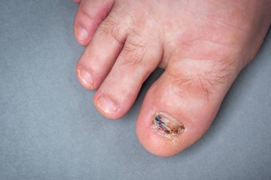 Onychomycosis fungal infection of toenail. Sick nail on the foot after damaging with tight shoes. 
