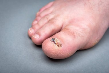 Onychomycosis fungal infection of toenail. Sick nail on the foot after damaging with tight shoes. 