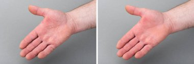 Derisi soyulmuş kuru bir adamın eli. Egzama dermatit tedavisinden önce ve sonra.