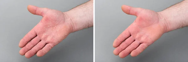 Torr Mans Hand Med Avflagnande Hud Före Och Efter Eksem — Stockfoto