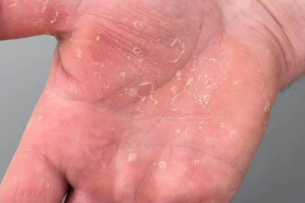 Dry man's hand with skin peeling off. Eczema dermatitis.