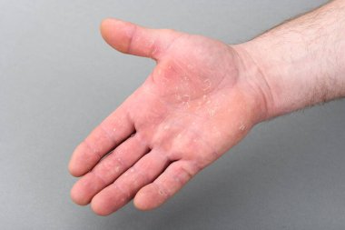 Derisi soyulmuş kuru bir adamın eli. Egzama dermatiti..
