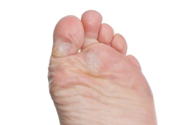 Callus on toes clipart