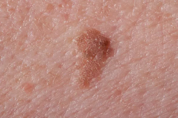 Liver spots — Stock Photo, Image