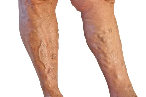 Varicose veins — Stock Photo, Image