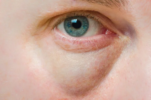 Puffy swollen eye — Stock Photo, Image