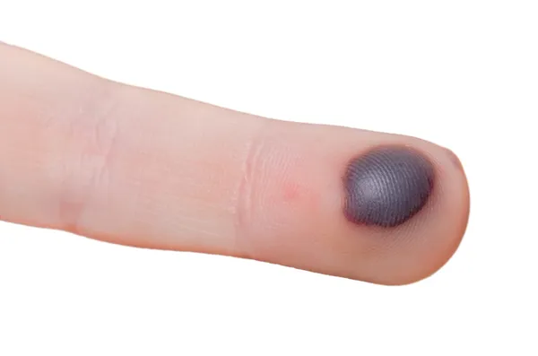 Blood blister — Stock Photo, Image